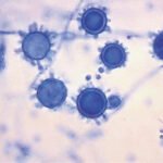 What is Valley Fever? Causes, Symptoms & Expert Treatment Guide